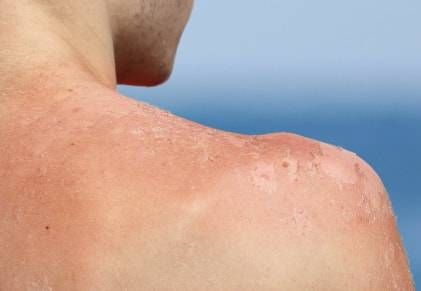 Pelle spellata Pelle spellata