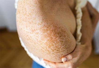 I sintomi di una carenza di melanina