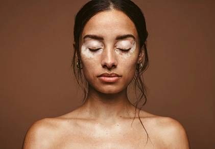 Mancanza di melanina: da cosa può dipendere?